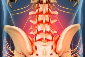 příčiny a příznaky osteochondrózy