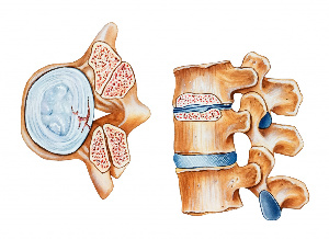 Osteochondróza