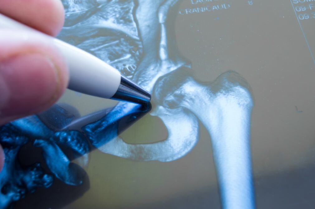 Artróza kyčelního kloubu na rentgenovém snímku