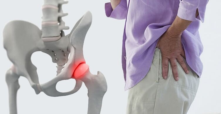bolest v oblasti kyčle - příznak artrózy kyčelního kloubu
