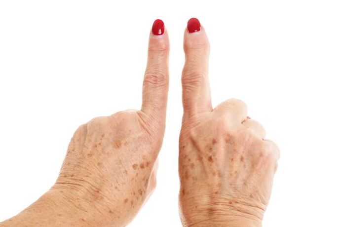 deformující artróza na prstech
