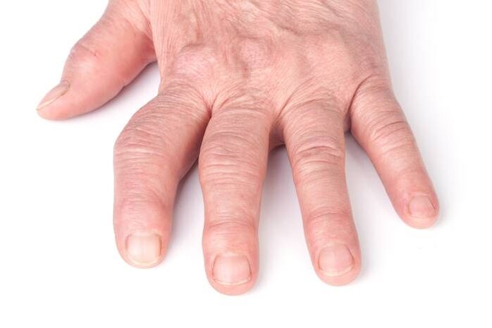 deformující artróza na rukou
