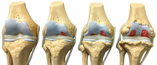 poškození kloubů v různých fázích vývoje artrózy kotníku