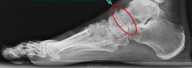 scintigrafie pro artrózu kotníku