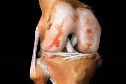 poškození kolenního kloubu s artrózou