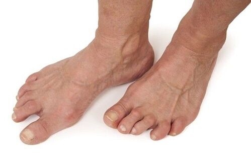 nohy postižené artrózou