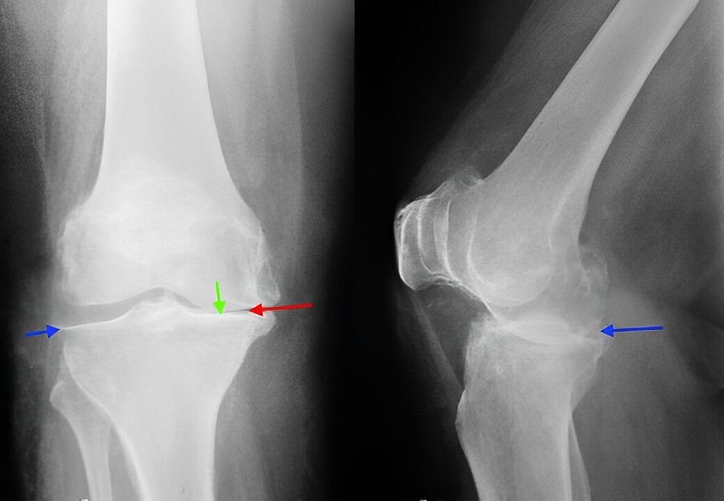 rentgen artrózy kolenního kloubu