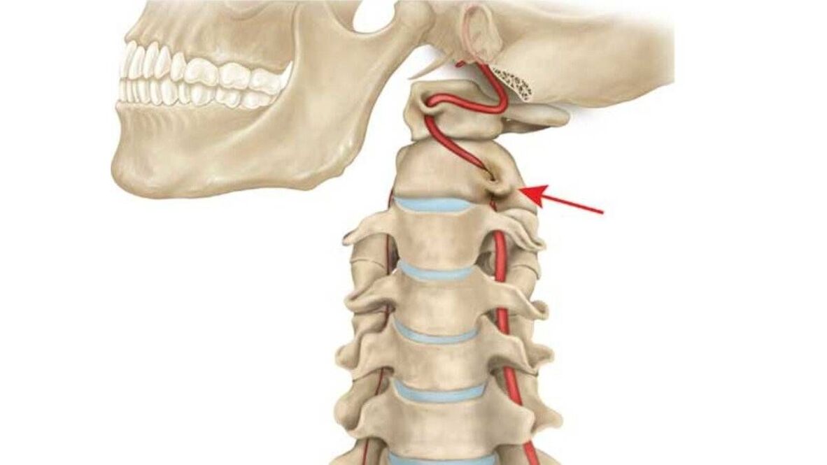 osteochondróza krční páteře