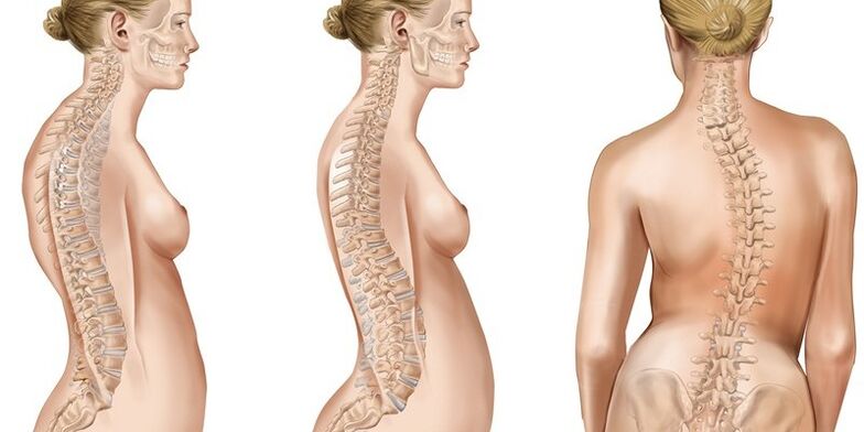 Skolióza hrudní páteře vyvolává bolesti lopatek